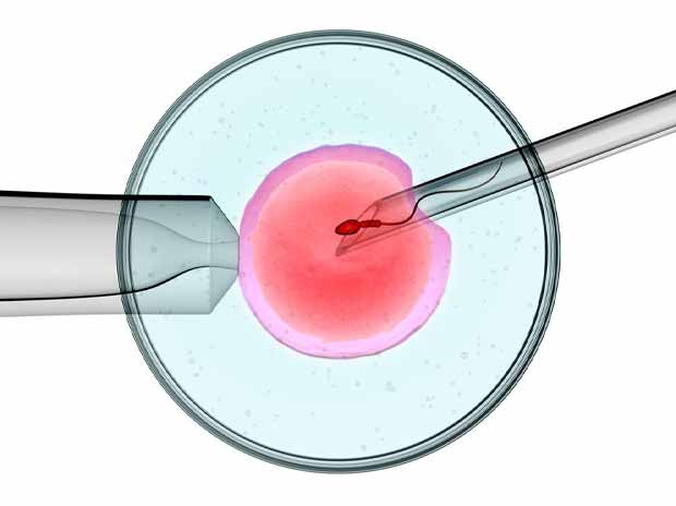 iniezione intracitoplasmatica dello spermatozoo