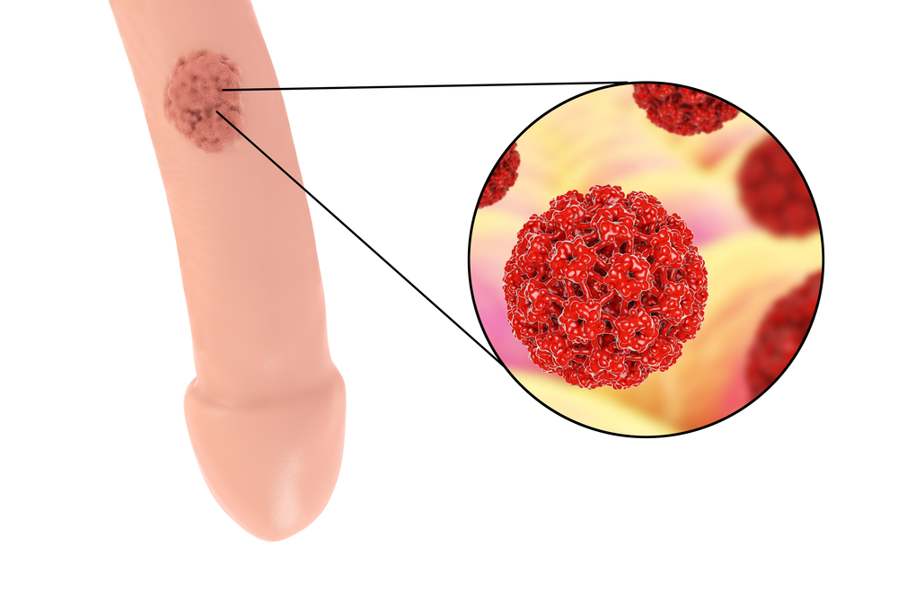 Infezione papilloma virus uomo