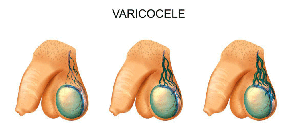 varicocele