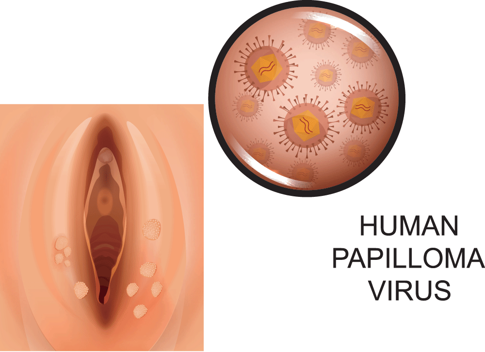 human papilloma virus ferfiaknal